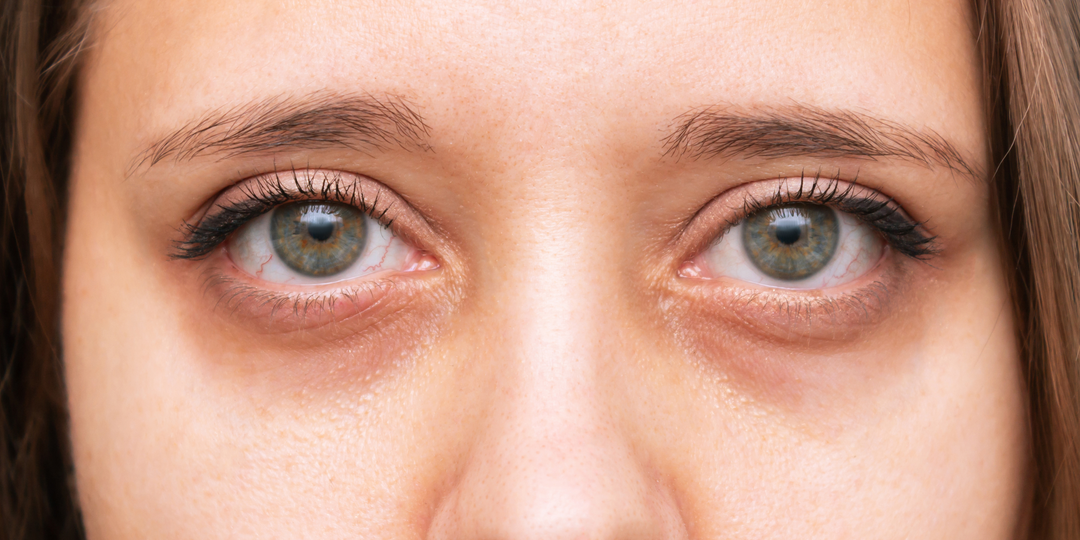 The New Era of Tear Trough Treatment: Why Less Filler Is More
