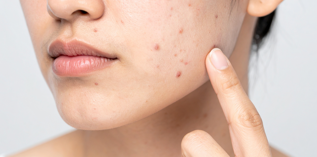 Clear Skin Starts Here: Understanding Acne & The Best Ways to Treat It