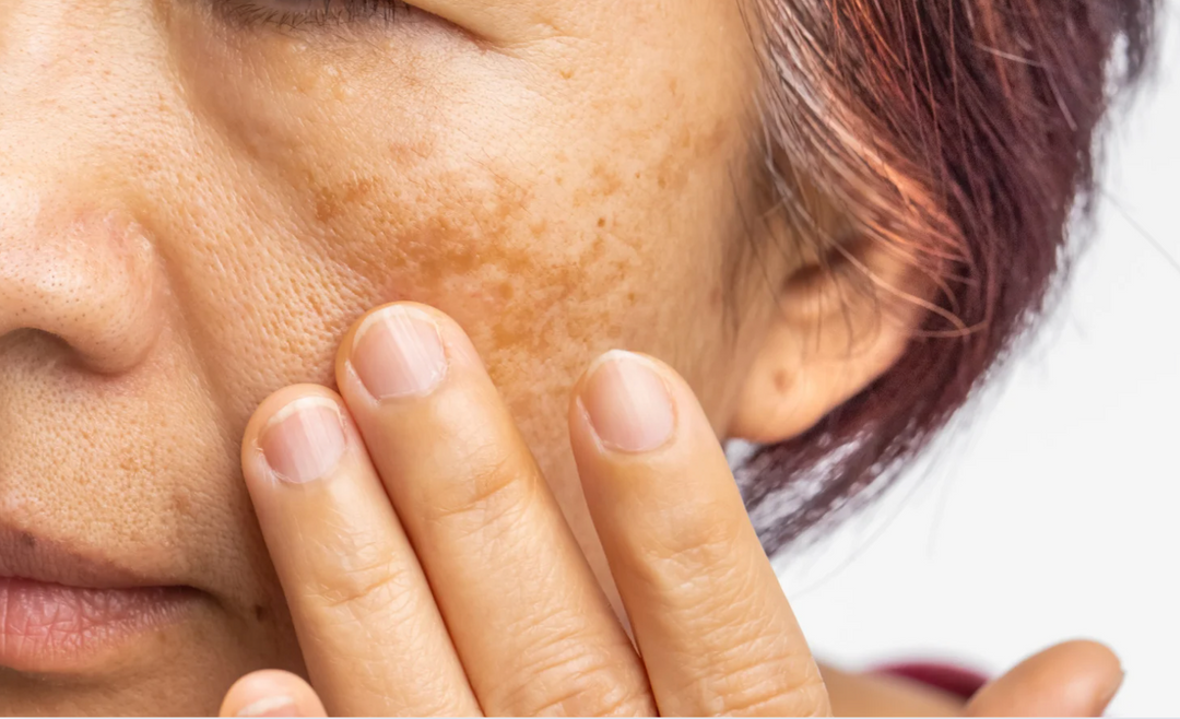 Goodbye Dark Spots: Your Guide to Treating Pigmentation & Melasma