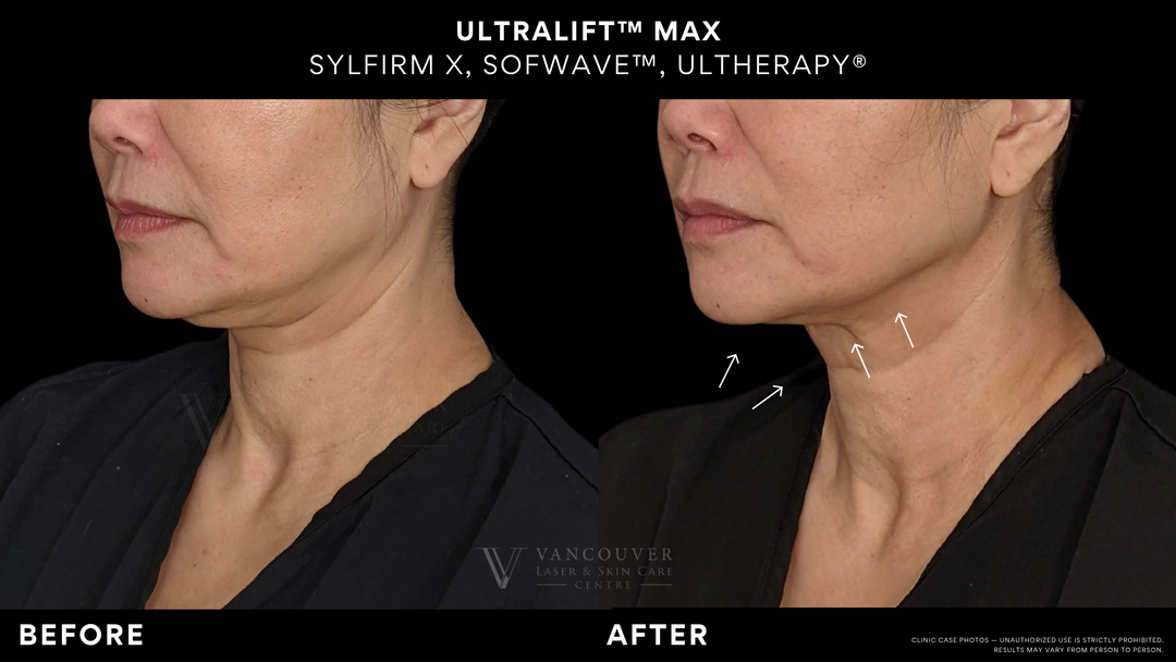 UltraLift Max | Sofwave + Sylfirm + Ultherapy