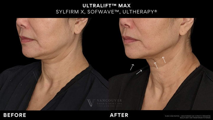 UltraLift Max | Sofwave + Sylfirm + Ultherapy