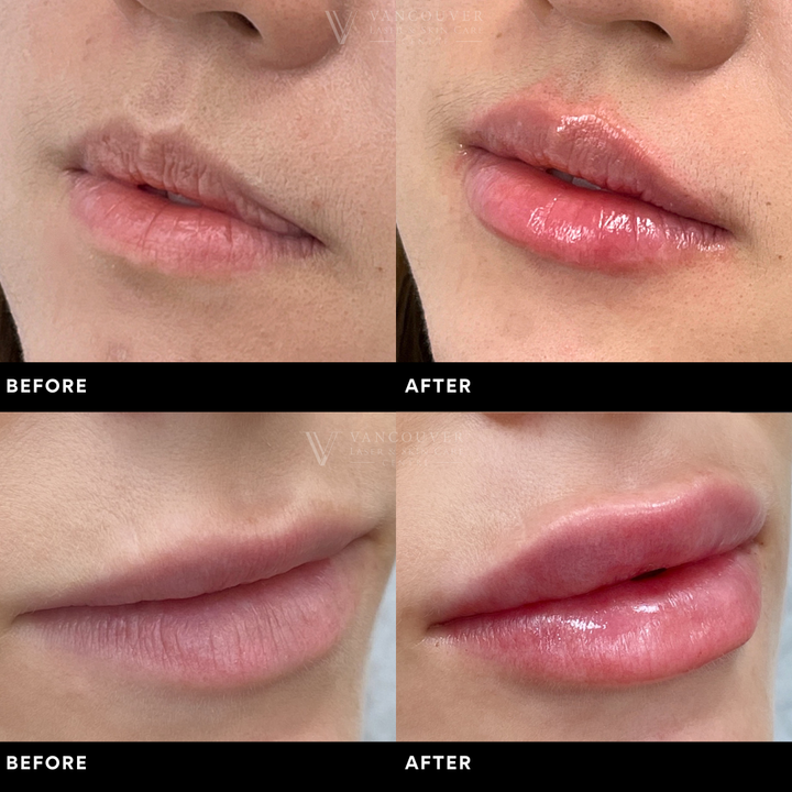 Dermal Filler - Anniversary Pricing