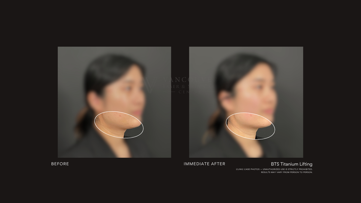 BTS Titanium Lifting