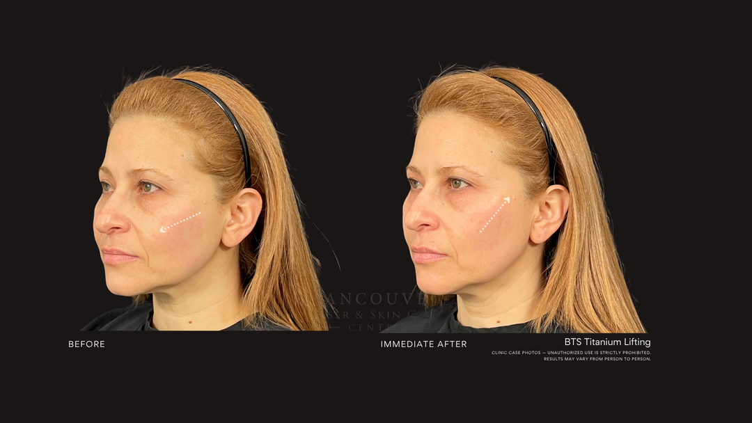 BTS Titanium Lifting