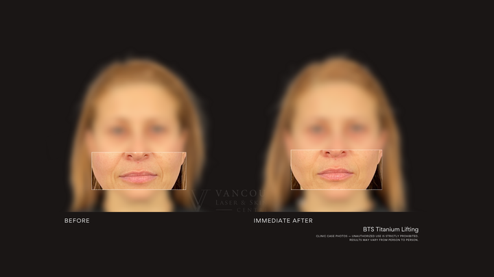 BTS Titanium Lifting