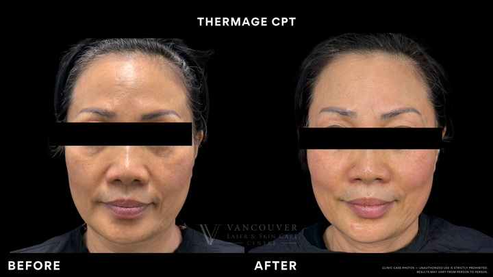 Thermage® FLX