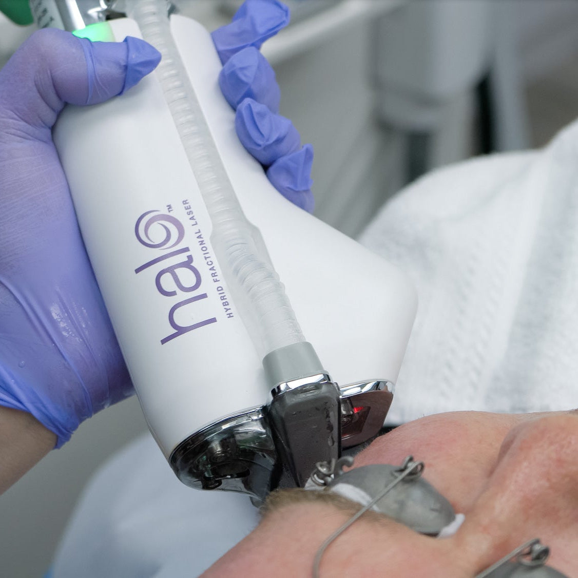 A close-up image of the Halo laser device being used on a patient's skin, primarily for resurfacing and rejuvenation purposes.