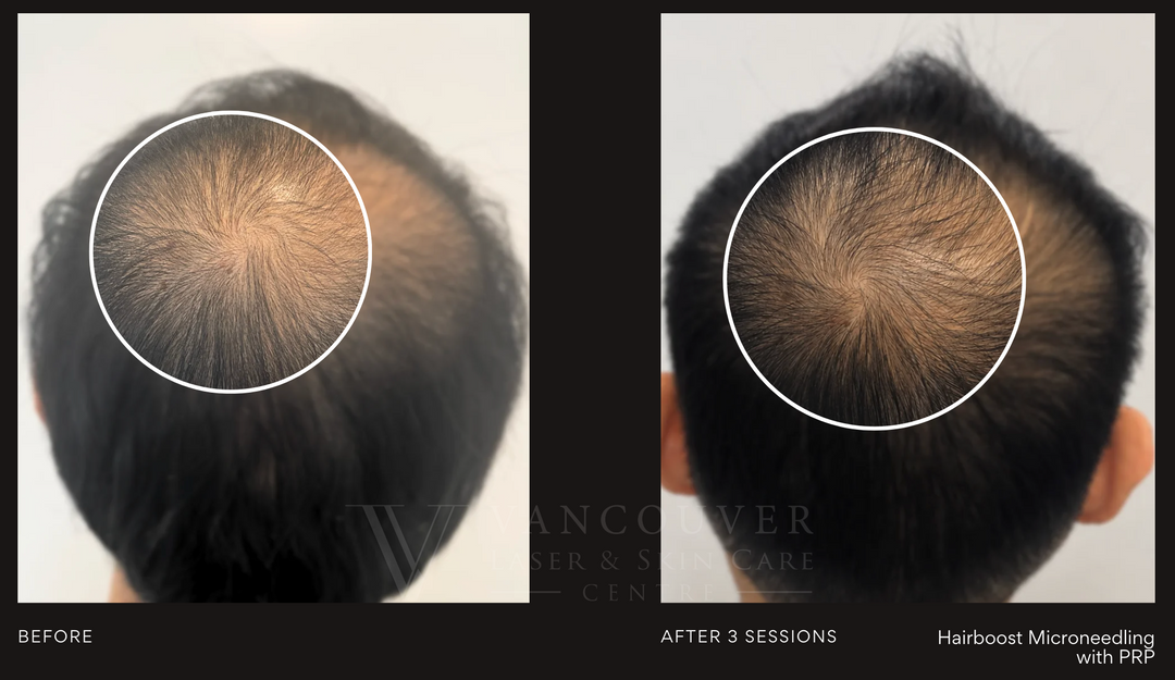 Hair Boost Package - Father’s Day Special