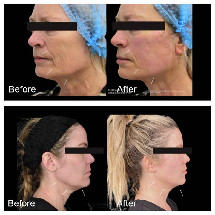 线雕提升 | 非手术面部轮廓提拉