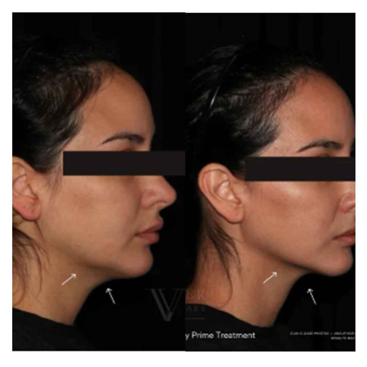 Ultherapy® Prime 新版超声刀