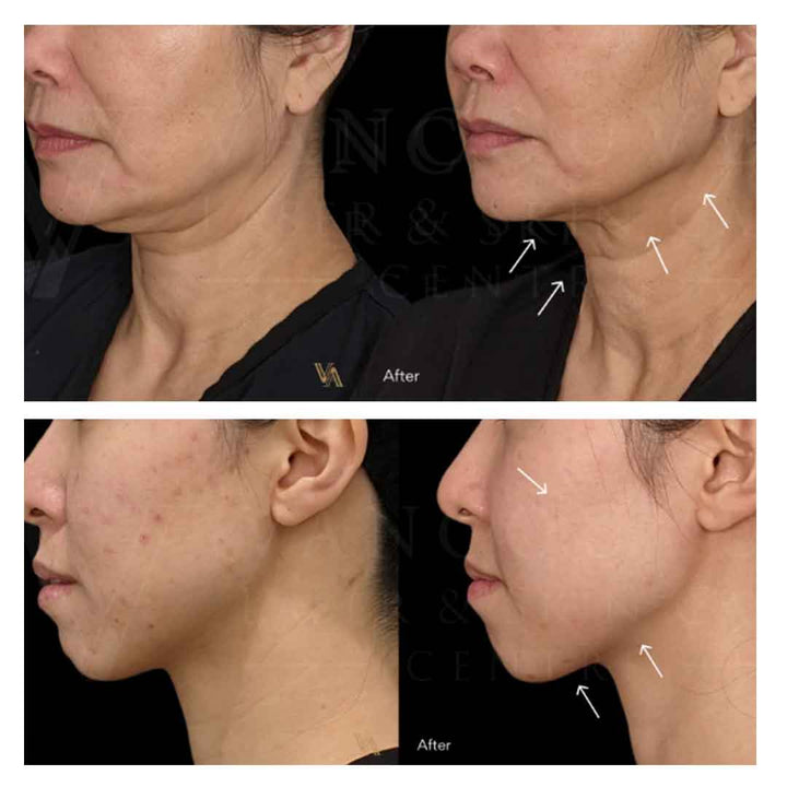 UltraLift | Sofwave索夫波 + Sylfirm X射频黄金微针