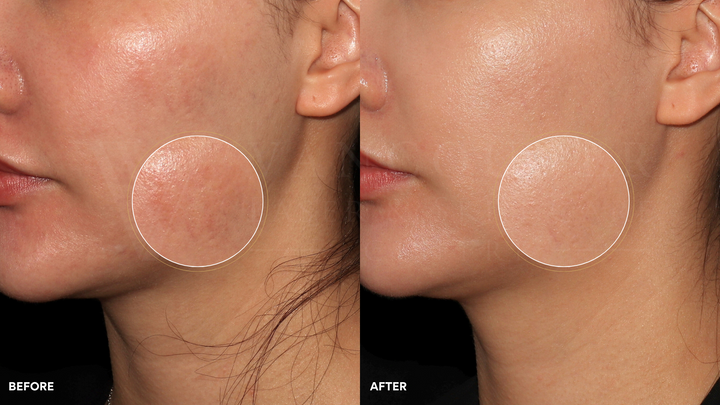 Microneedling