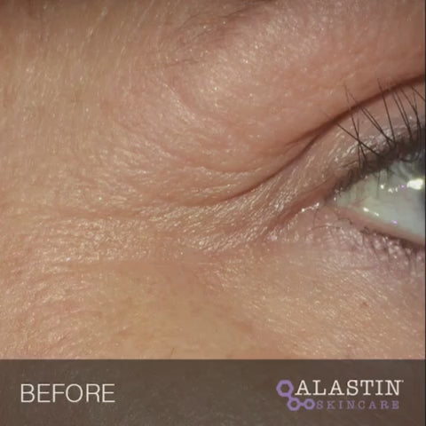 Alastin Restorative Eye Complex